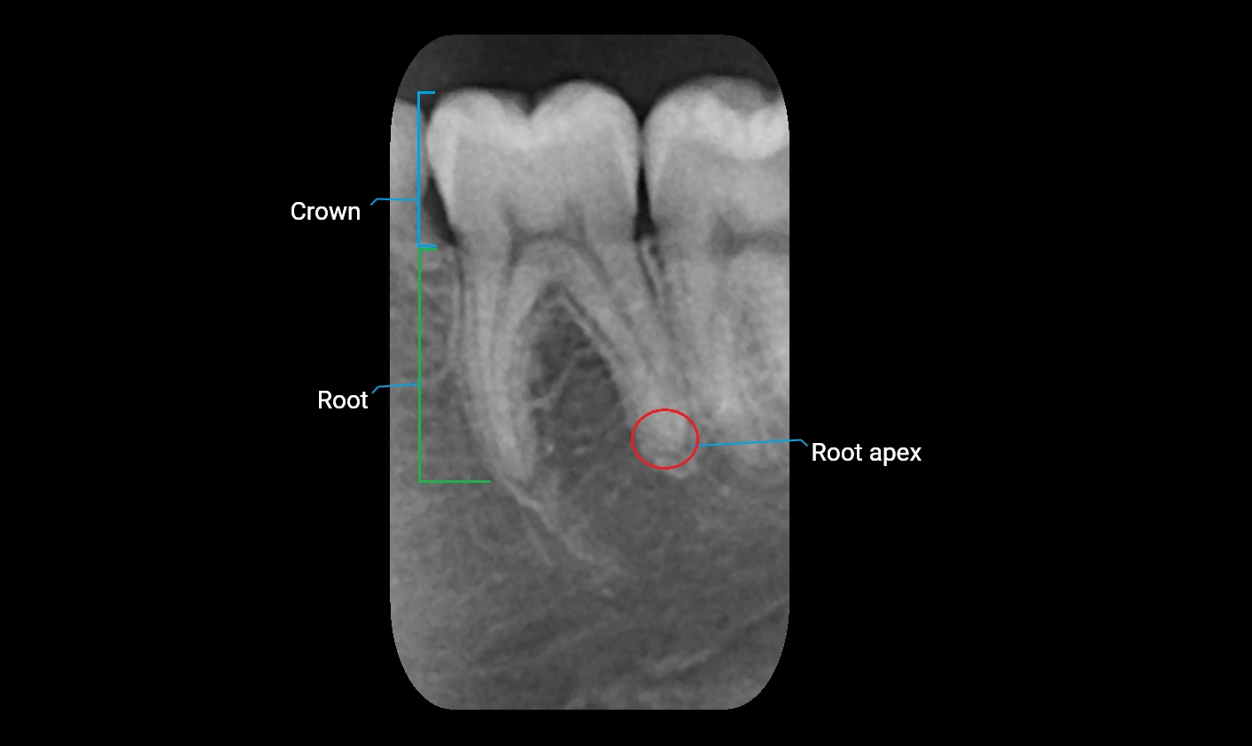 X ray Dental anatomy 2.webp